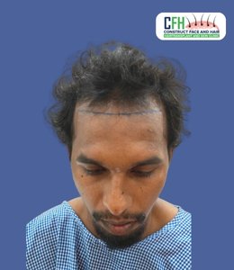 Hair Transplant Before - Case 01