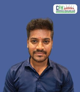Hair Transplant After - Case 02