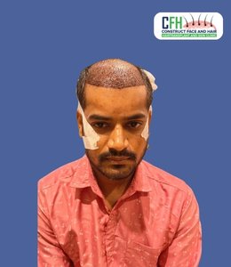 Hair Transplant Before - Case 02