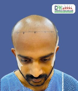 Hair Transplant Before - Case 03