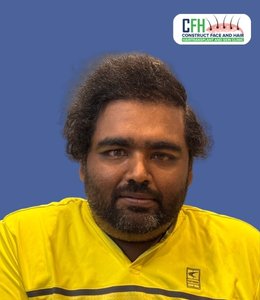 Hair Transplant After - Case 04