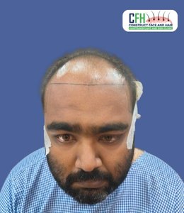 Hair Transplant Before - Case 04