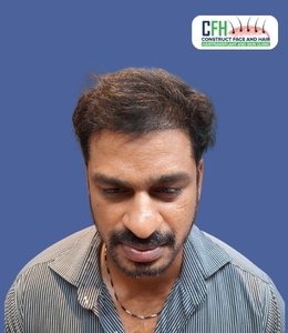 Hair Transplant After - Case 05