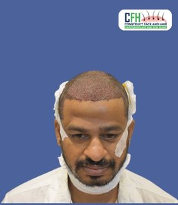 Hair Transplant Before - Case 05