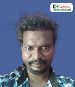 Hair Transplant After - Case 06