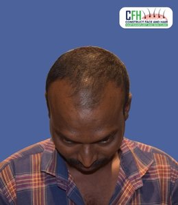 Hair Transplant Before - Case 06