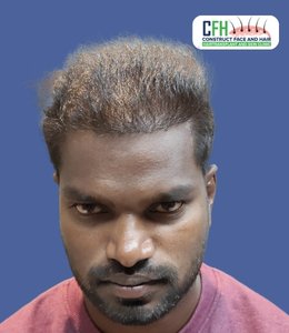 Hair Transplant After - Case 08