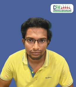 Hair Transplant After - Case 09