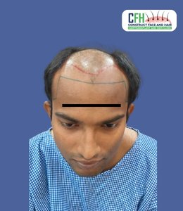 Hair Transplant Before - Case 09