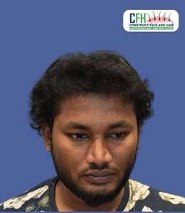 Hair Transplant After - Case 10