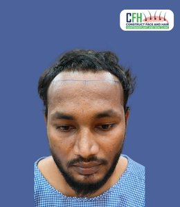 Hair Transplant Before - Case 10