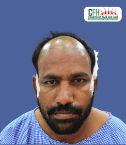 Hair Transplant Before - Case 11