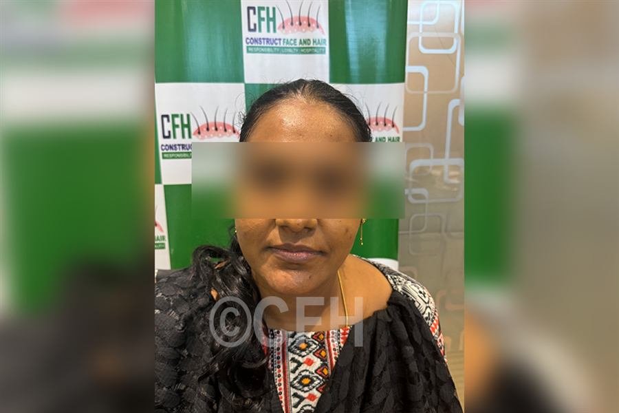 Chemical peel after photo, case 1