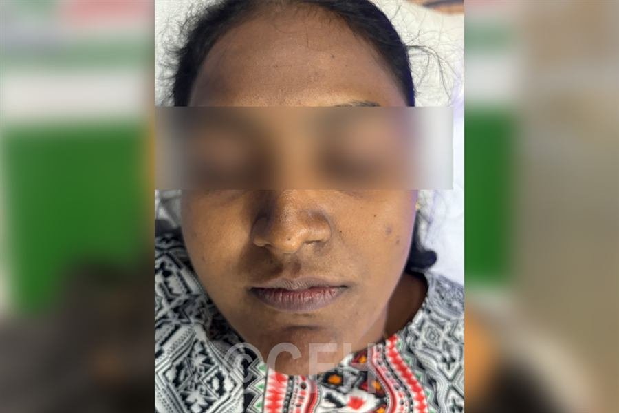 Chemical peel before photo, case 1