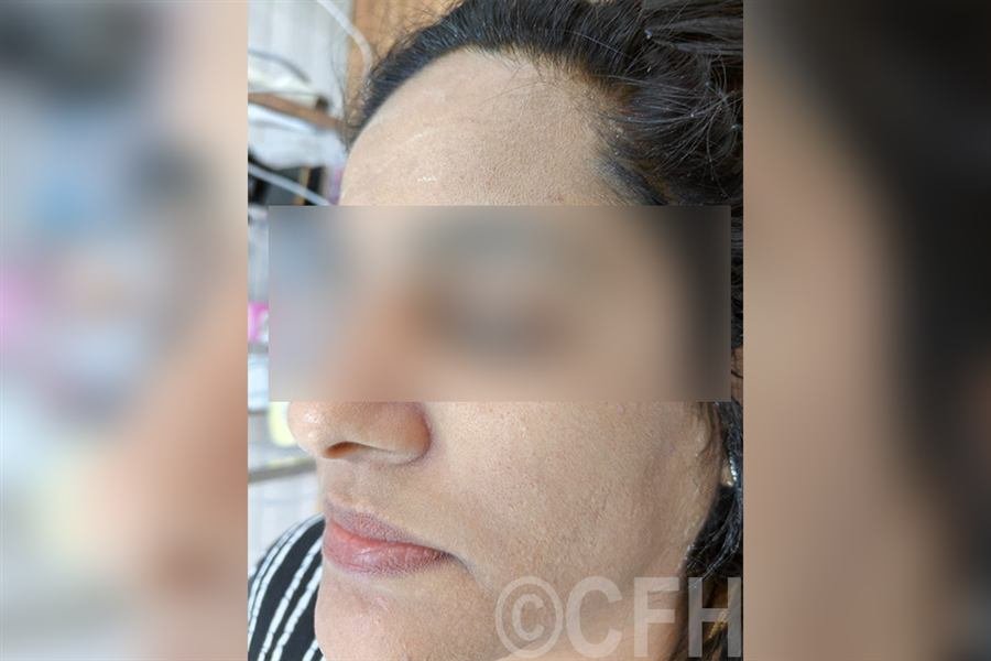 Chemical peel after photo, case 3