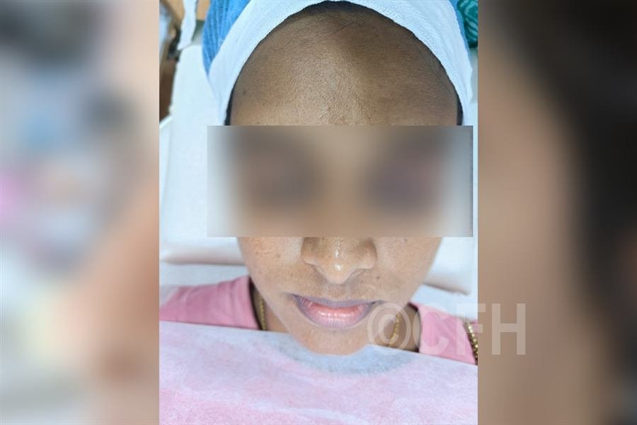 Chemical peel before photo, case 3