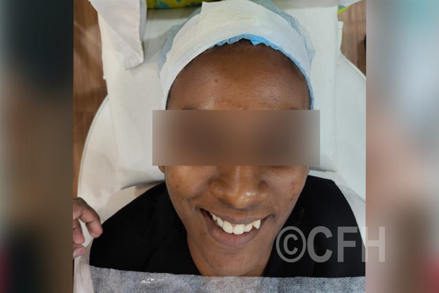 HydraFacial before photo, case 2