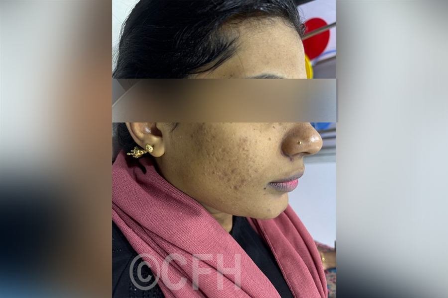 HydraFacial after photo, case 3