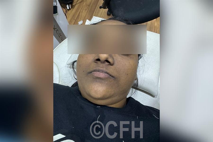 HydraFacial after photo, case 4