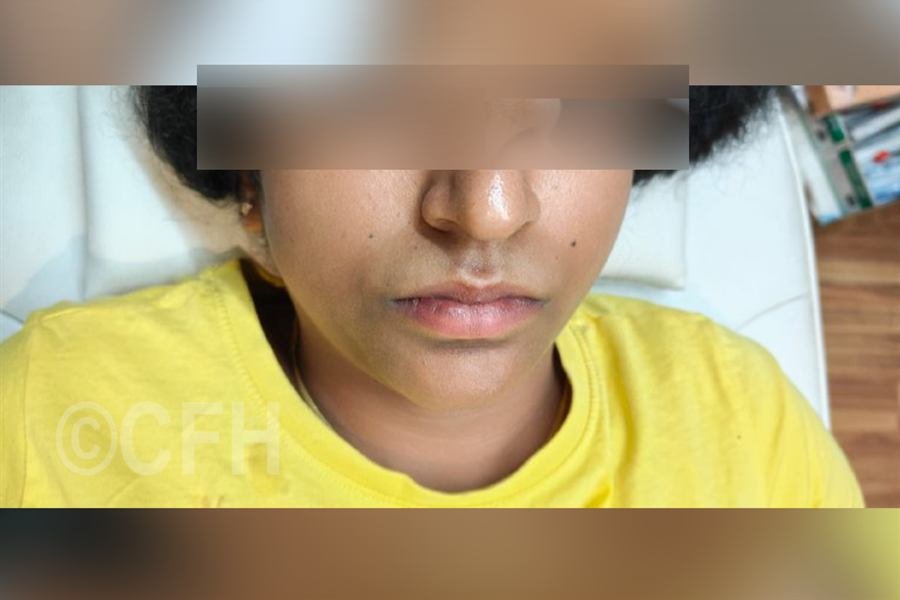 Laser hair removal after photo, case 1