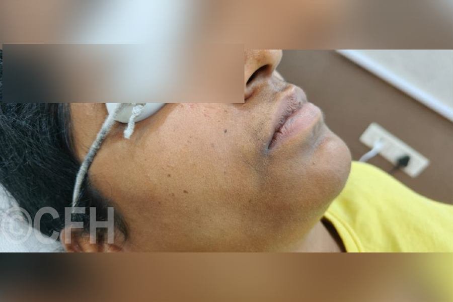 Laser hair removal before photo, case 1