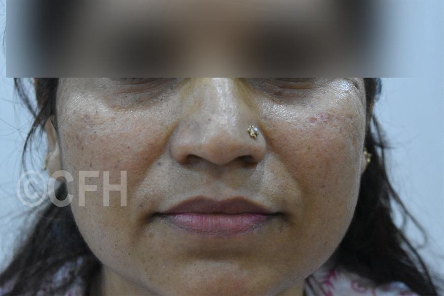 Wart and mole removal after photo, case 2